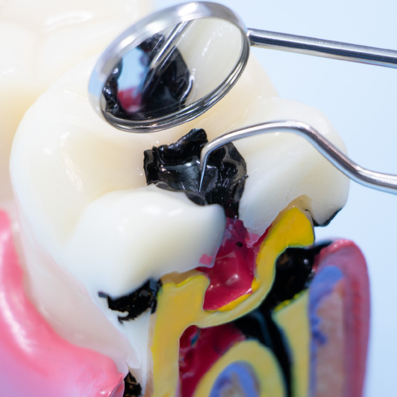 精密さが鍵：「歯の根の治療」（根管治療）へのこだわり