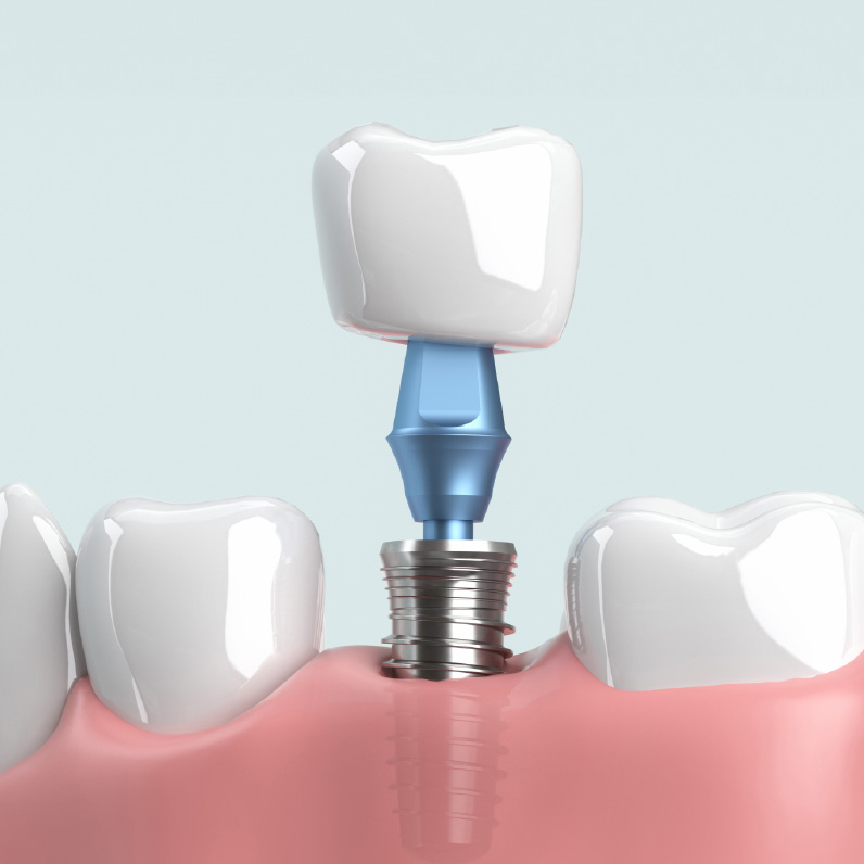 インプラント治療で大切な事は「これで最後にする」事です