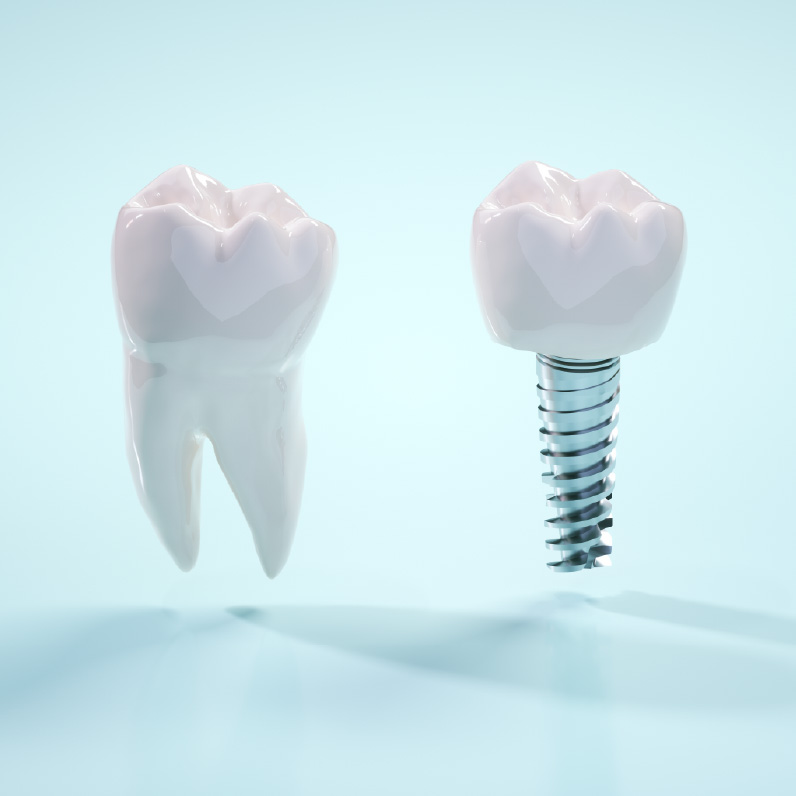 インプラント治療は、成功率の高い治療