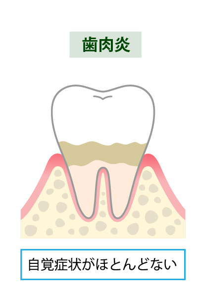 歯周病治療のステップ