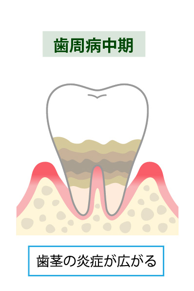 歯周病治療のステップ