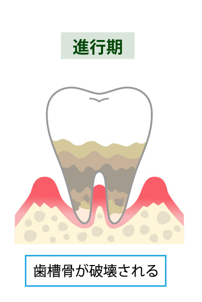 歯周病治療のステップ